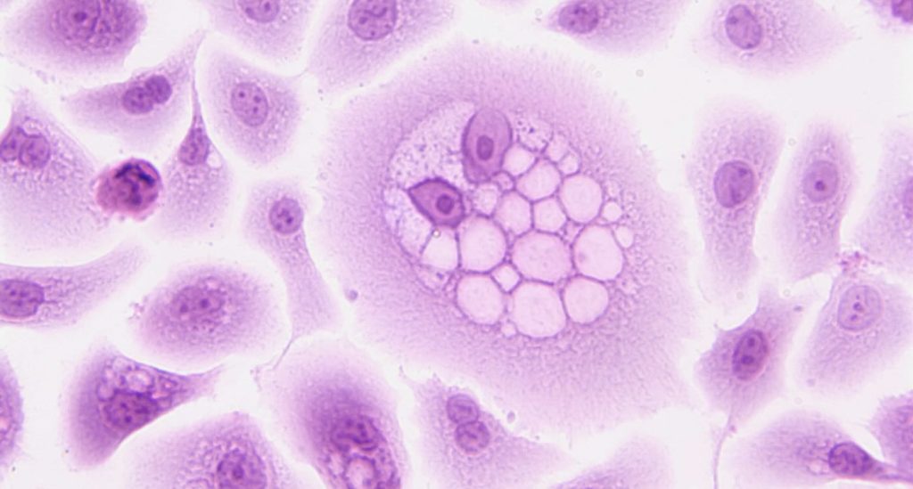 Reversing the Tide: A Groundbreaking Enzyme Targeting Method Could Slash Cancer Growth by 77% in Melanoma and Colorectal Tumors