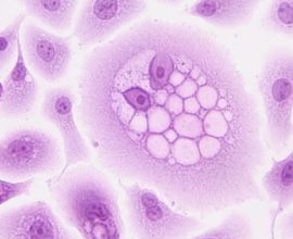 Reversing the Tide: A Groundbreaking Enzyme Targeting Method Could Slash Cancer Growth by 77% in Melanoma and Colorectal Tumors