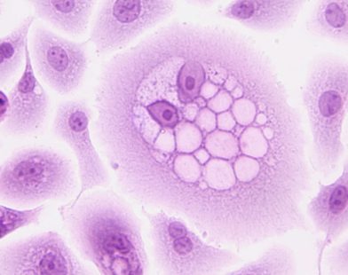 Reversing the Tide: A Groundbreaking Enzyme Targeting Method Could Slash Cancer Growth by 77% in Melanoma and Colorectal Tumors