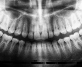 Unlocking Nature's Gift: The Hidden Stem Cells in Wisdom Teeth That Could Transform Medicine!