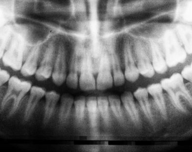 Unlocking Nature's Gift: The Hidden Stem Cells in Wisdom Teeth That Could Transform Medicine!