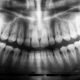 Unlocking Nature's Gift: The Hidden Stem Cells in Wisdom Teeth That Could Transform Medicine!