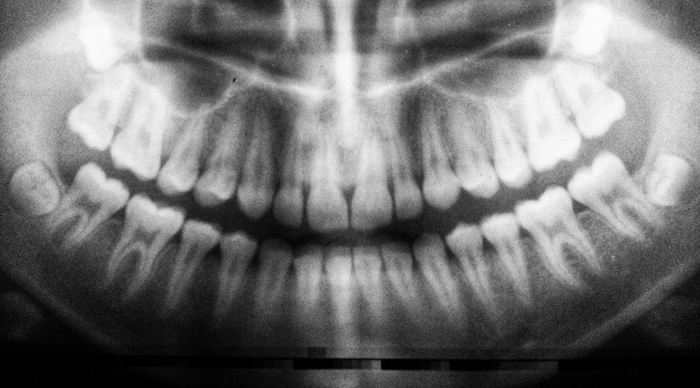 Unlocking Nature's Gift: The Hidden Stem Cells in Wisdom Teeth That Could Transform Medicine!