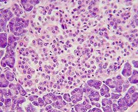 From Dependency to Independence: Type 1 Diabetic Triumphs with Groundbreaking Gene-Edited Cell Breakthrough