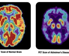 Breakthrough Discovery: Tiny Protein Emerges as a Hopeful Ally in the Fight Against Alzheimer’s Disease