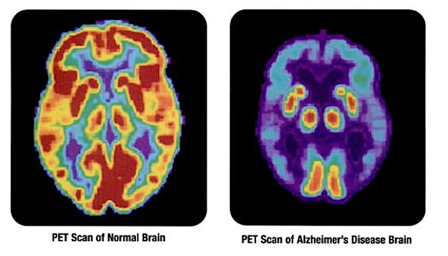Breakthrough Discovery: Tiny Protein Emerges as a Hopeful Ally in the Fight Against Alzheimer’s Disease