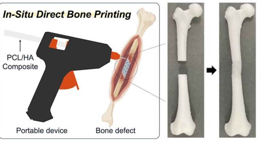 Revolutionizing Healing: The 3D-Printing 'Glue Gun' That Mends Bone Fractures in Real Time, Bringing Hope and Wholeness to Surgery