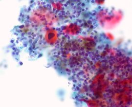 Hope on the Horizon: Breakthrough Drug Trial Offers Rapid Tumor Reduction for Head and Neck Cancer Patients