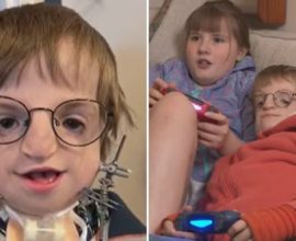 From Pain to Possibility: Surgeons Craft a New Beginning for Young Boy Using His Own Rib Bone