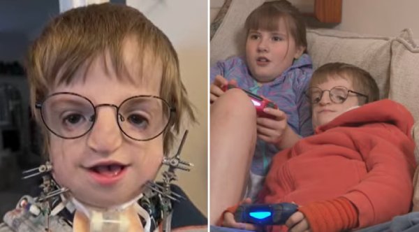 From Pain to Possibility: Surgeons Craft a New Beginning for Young Boy Using His Own Rib Bone