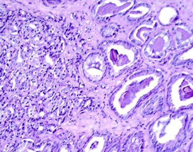 Reviving Hope: Breakthrough Drug Combo Gives New Life to Prostate Cancer Warriors